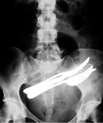 Хорошая цена фильм прозрачное КНД-А медицинского отображения рентгеновского снимка 11ин кс 14ин сухой для АГФА онлайн